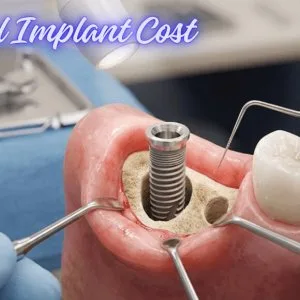 Understanding tooth implant cost in mumbai before treatment