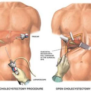 Gallbladder stone treatment in delhi by dr neeraj goel