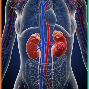Kidney stone checkup package in hyderabad