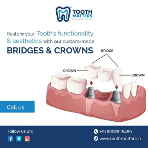 Advanced dental implants at the best dental clinic in kondapur