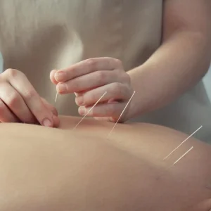 Acupuncture nyc sports medicine dry needling pain manageme