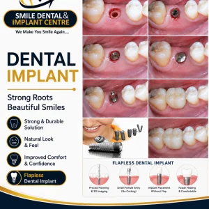 Precisionfocused flapless dental implants near me