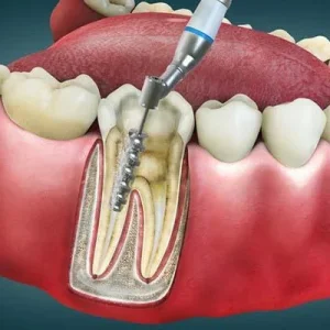 Why advanced painless root canal treatment with microscopic