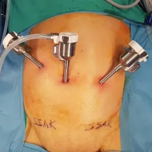 Hiatal hernia treatment