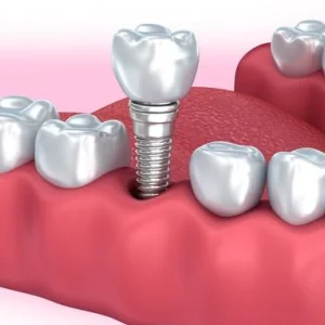 Expert implants for missing teeth in pune by dr hileri mori