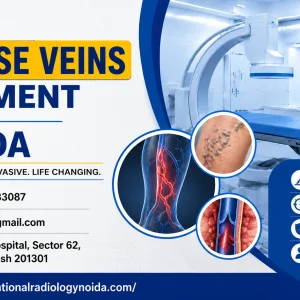 Varicose veins treatment in noida