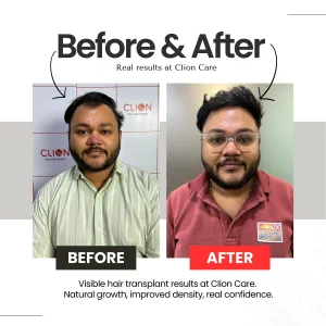 Hair transplant cost in vadodara affordable hair restoration