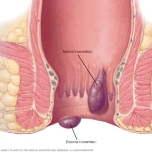 Expert piles surgeon in delhi advanced piles care
