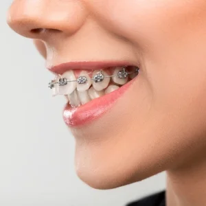 Dental implants fort worth restore your smile with confidence